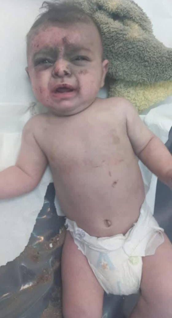 هذا الطفل تم انتشاله من تحت الركام في ضربة حي السلم الرجاء لمن يعرفه التواصل مع المستشفى الرسول الاعظم